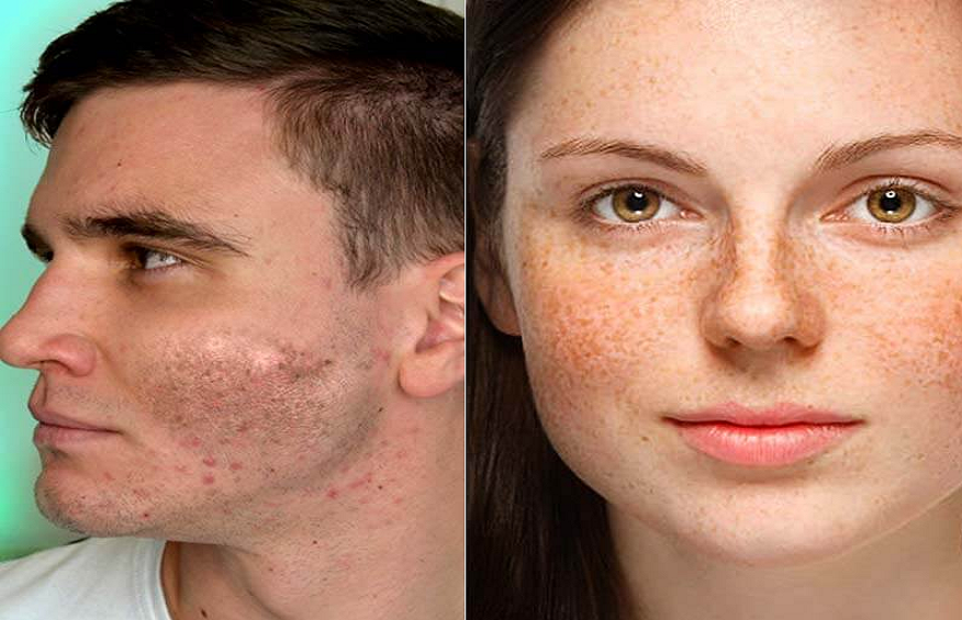 hyperpigmentation