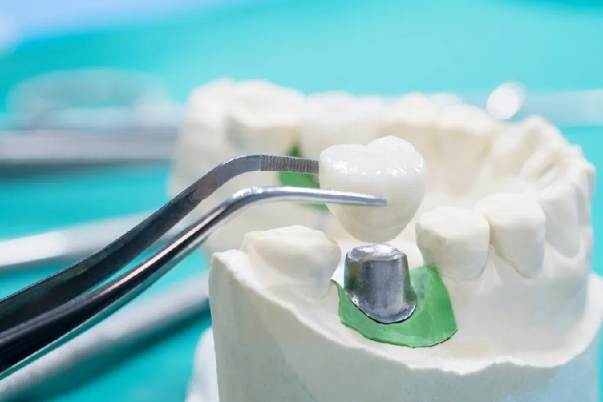 Restore Damaged Teeth with Modern Dental Crown Treatments
